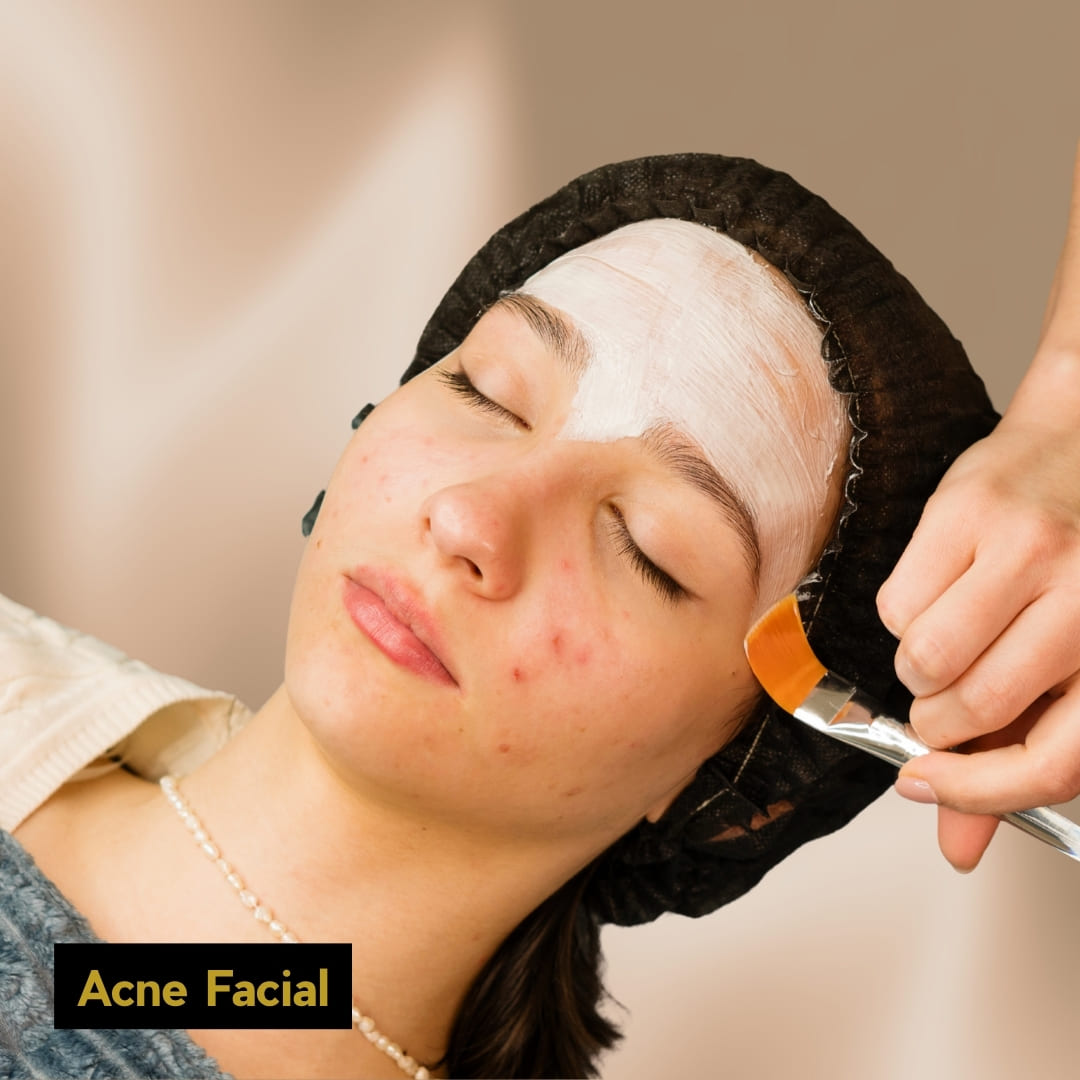 Acne Facial