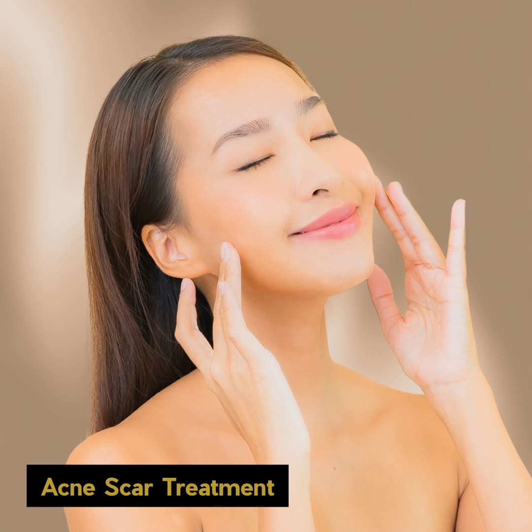 Acne Scar Treatment