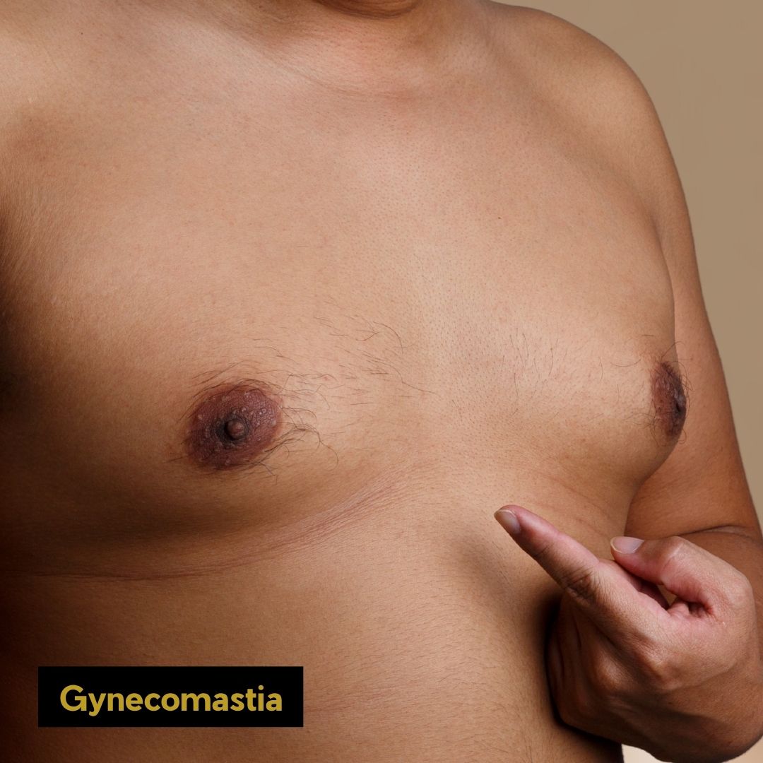Gynecomastia