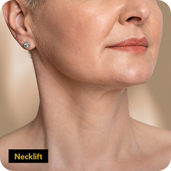 neck lift