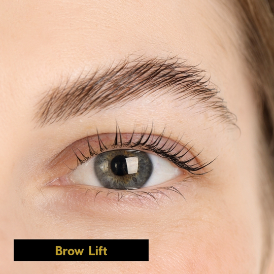 Brow Lift