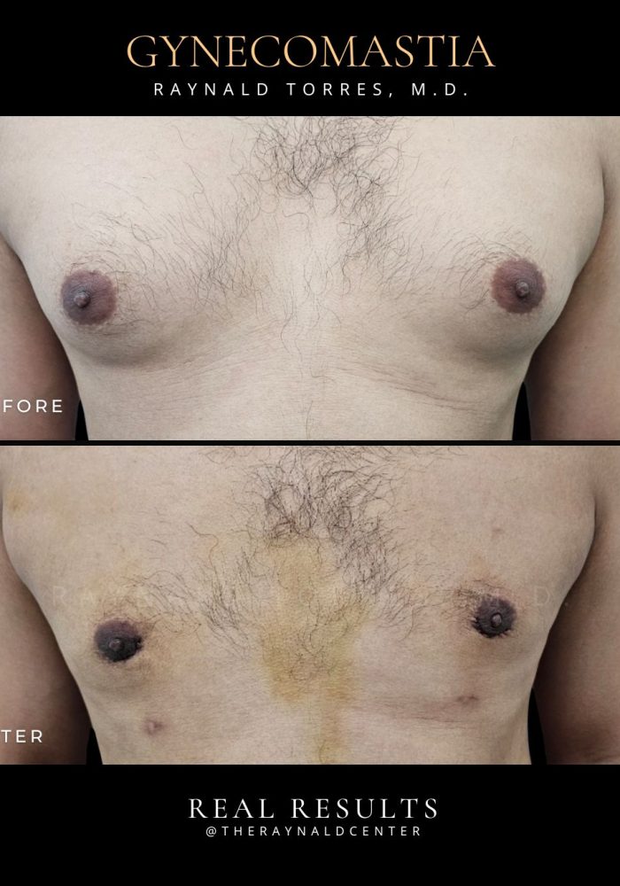 Gynecomastia