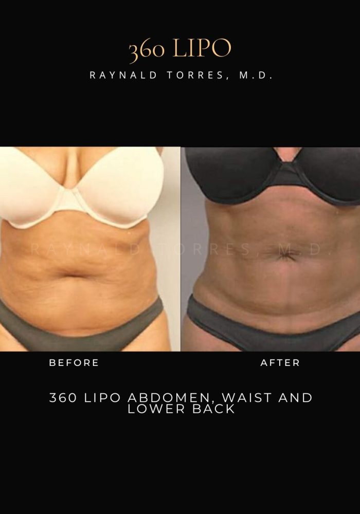 3D Lipo