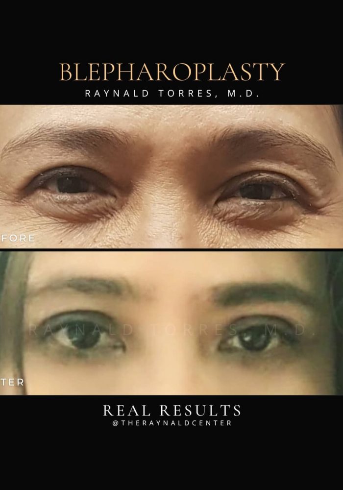 Blepharoplasty1