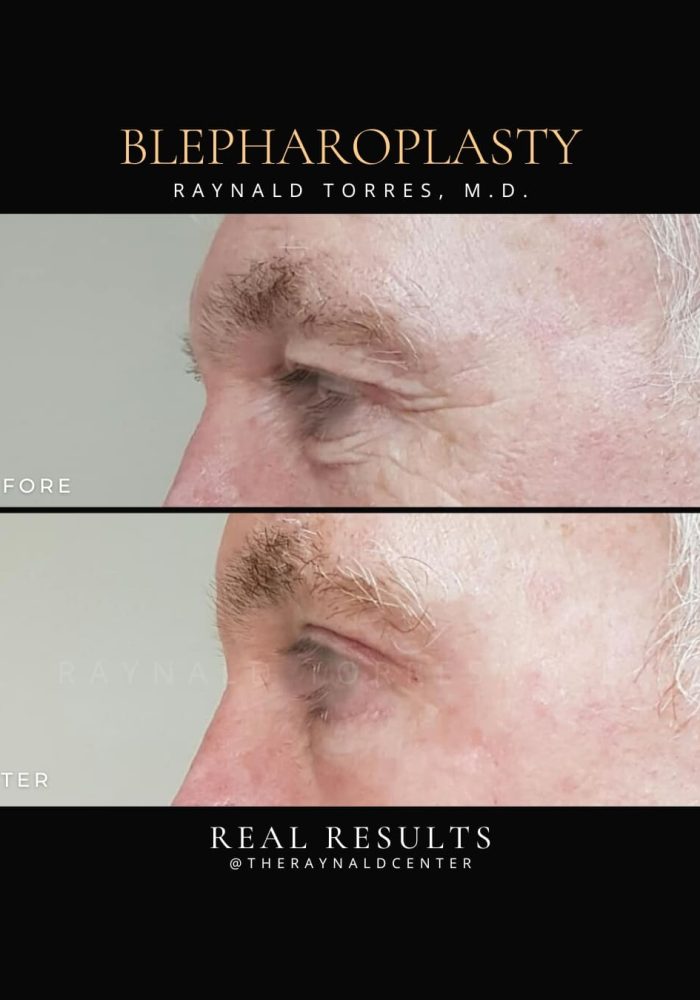 Blepharoplasty2