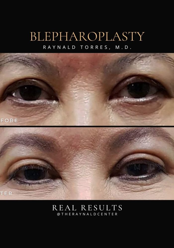 Blepharoplasty3