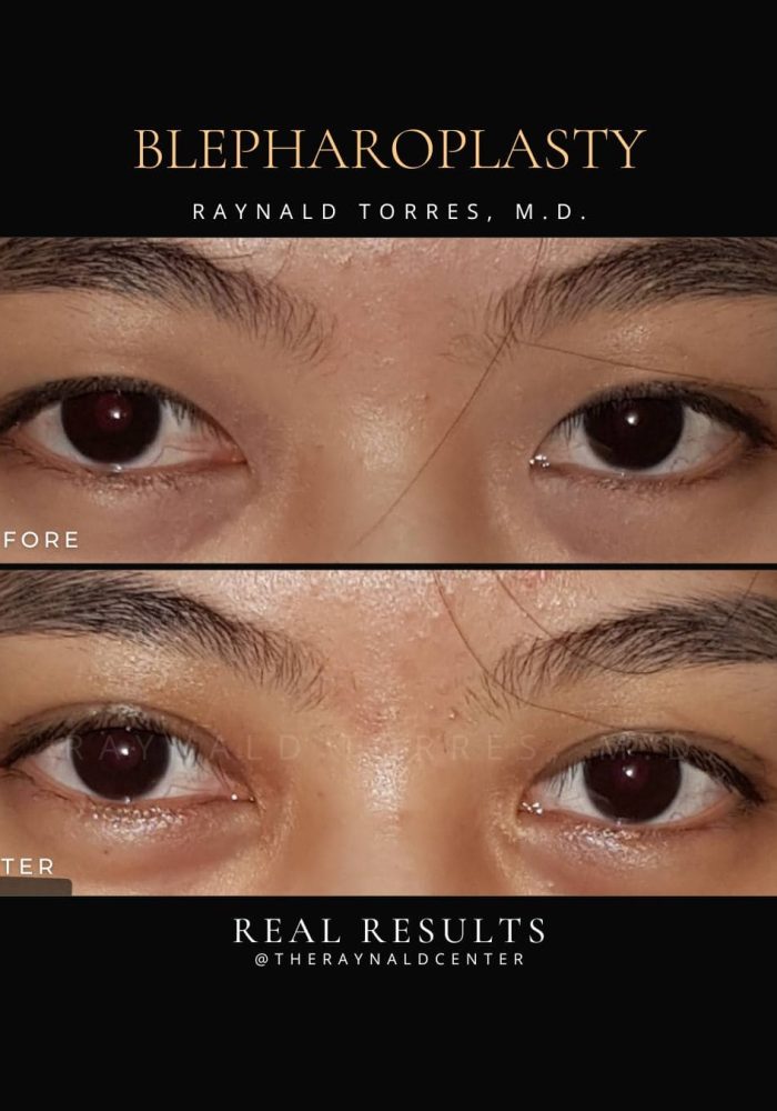 Blepharoplasty4