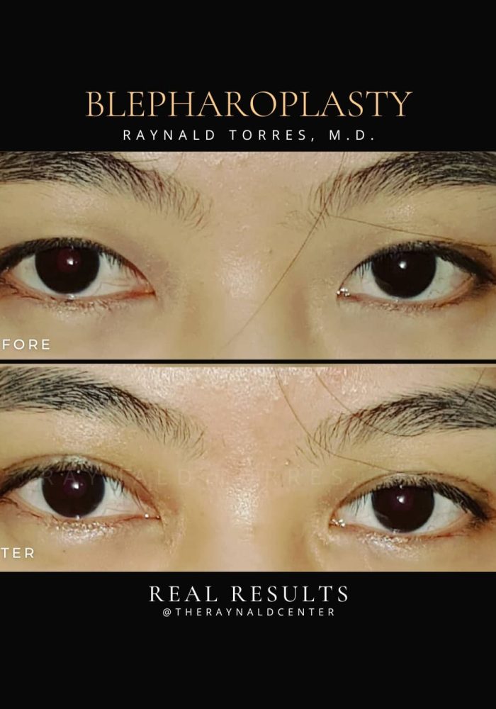 Blepharoplasty5