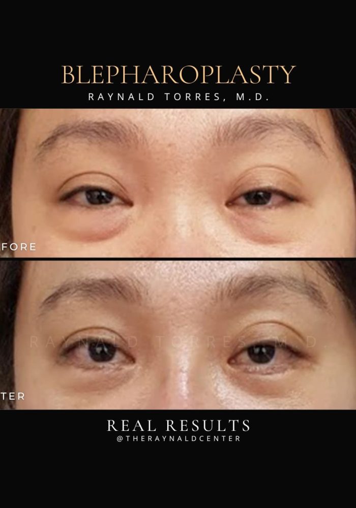 Blepharoplasty6