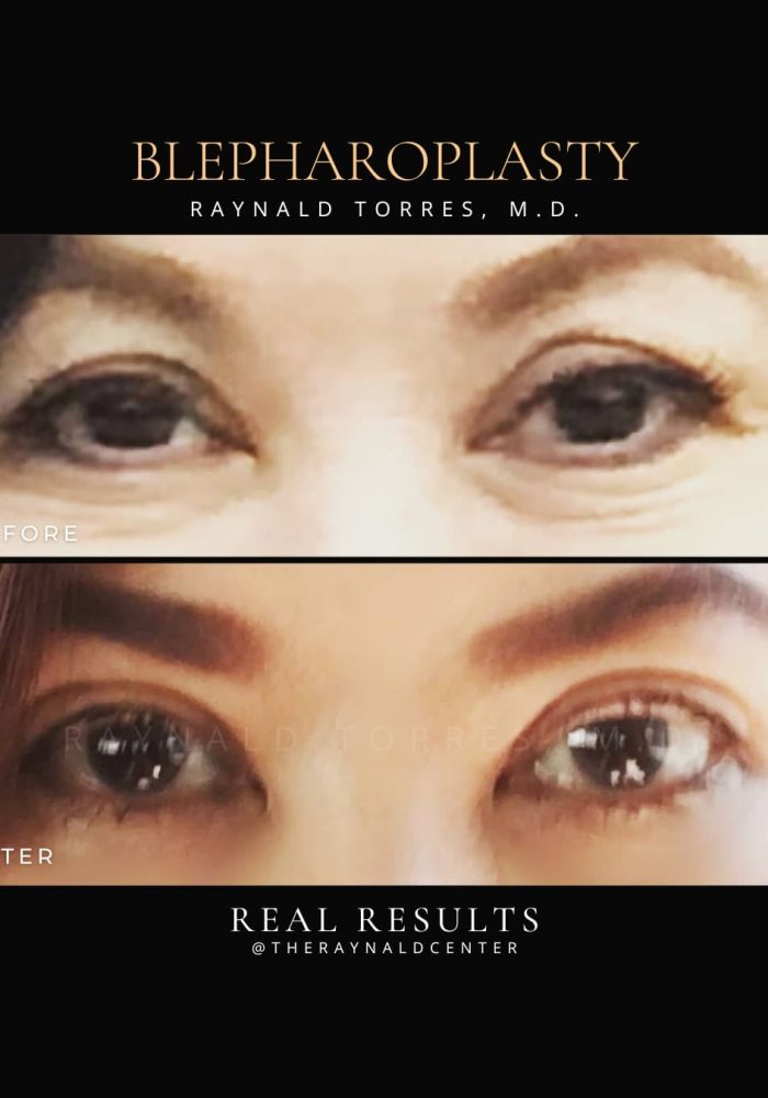 Blepharoplasty7