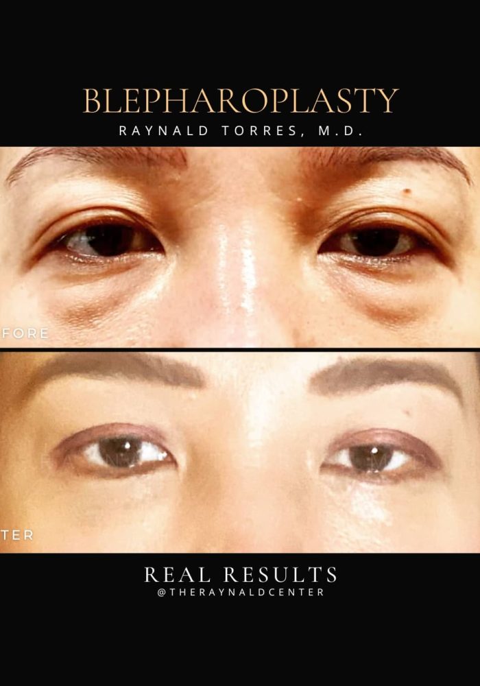 Blepharoplasty8
