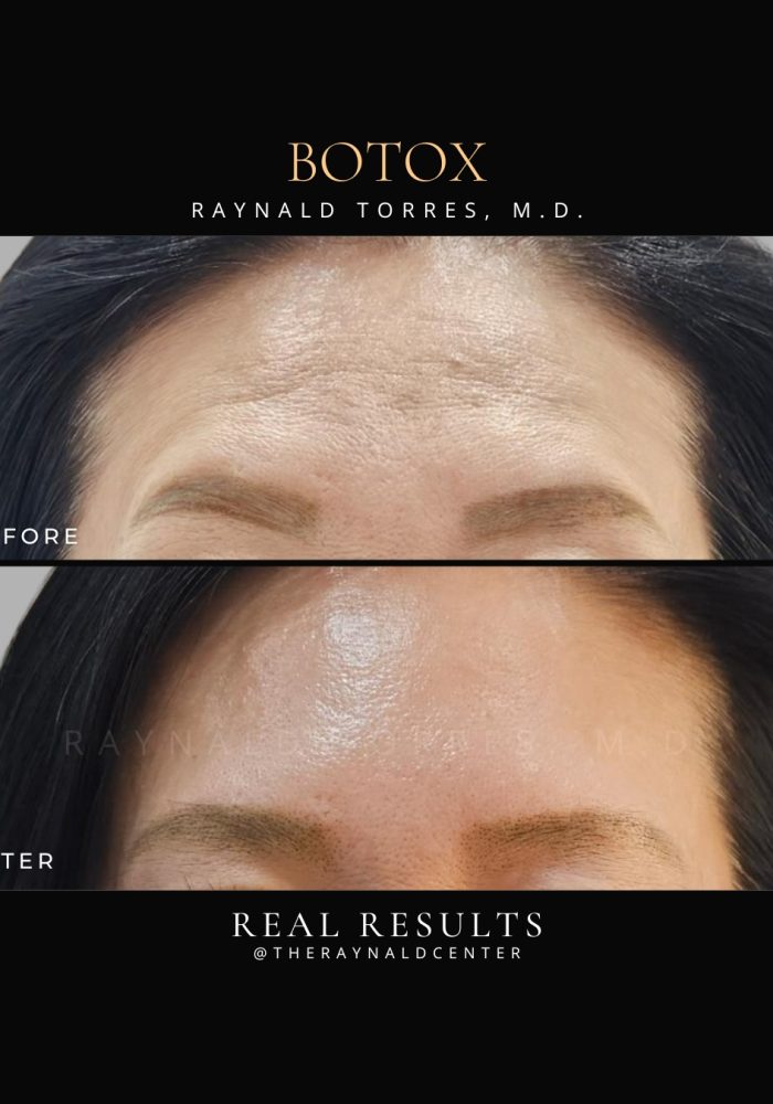 Botox_Before and After 2025
