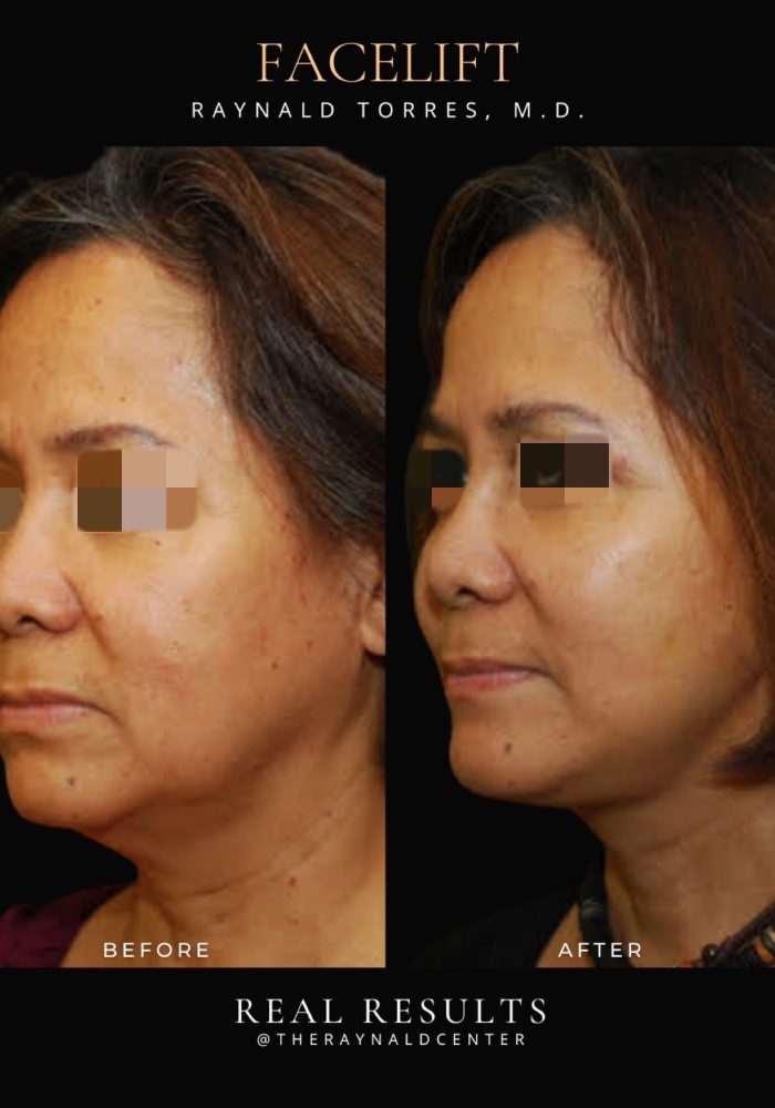 Portait_FACELIFT_Before and After Template 2025 - 21