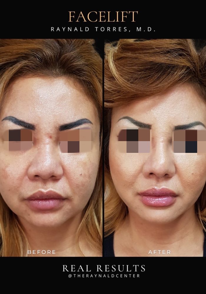 Portait_FACELIFT_Before and After Template 2025 - 22