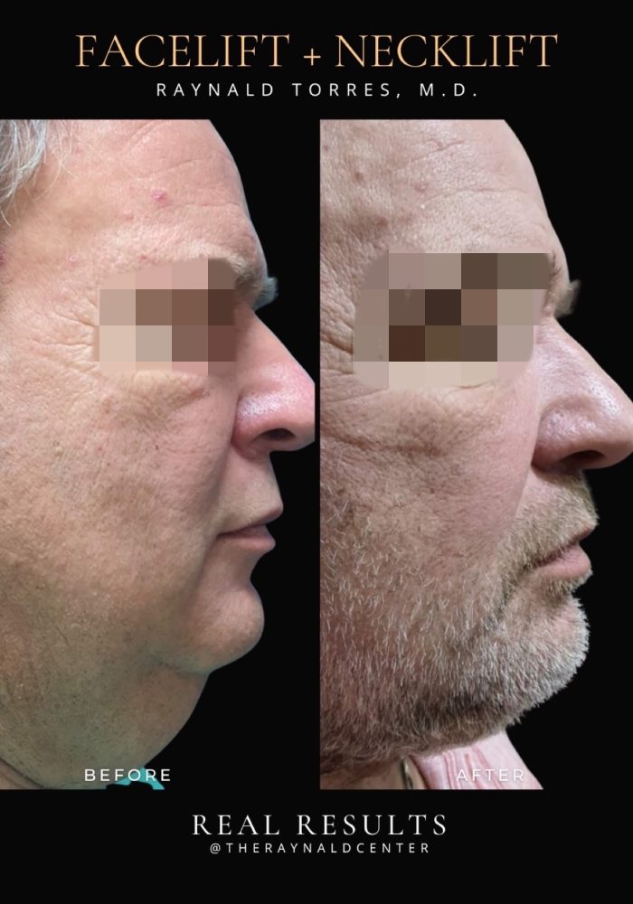 Portait_FACELIFT_Before and After Template 2025 - 24