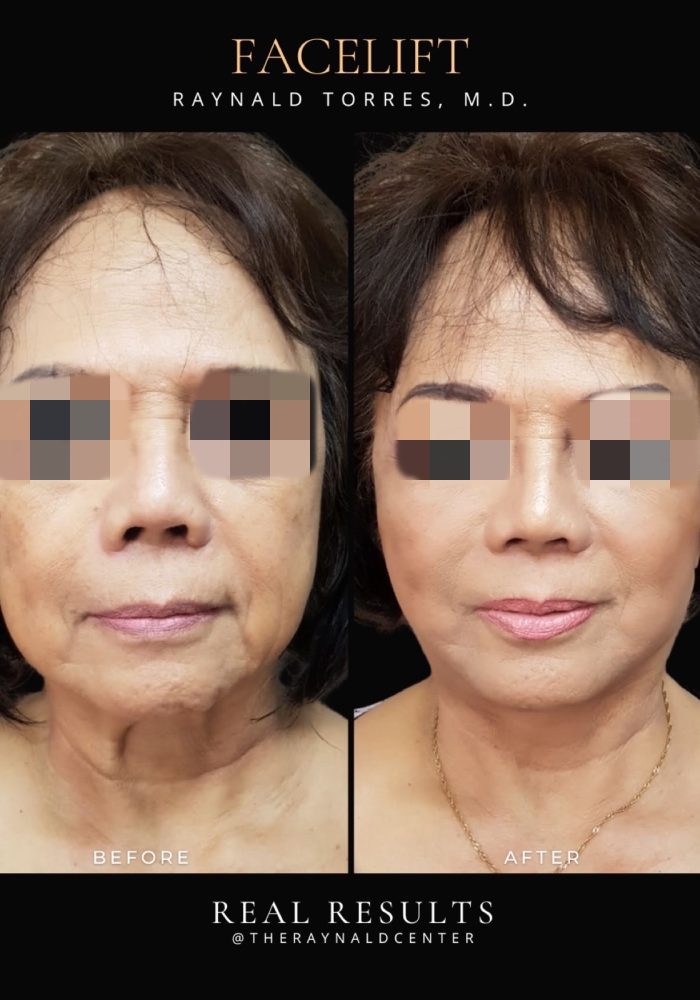 Portait_FACELIFT_Before and After Template 2025 - 25