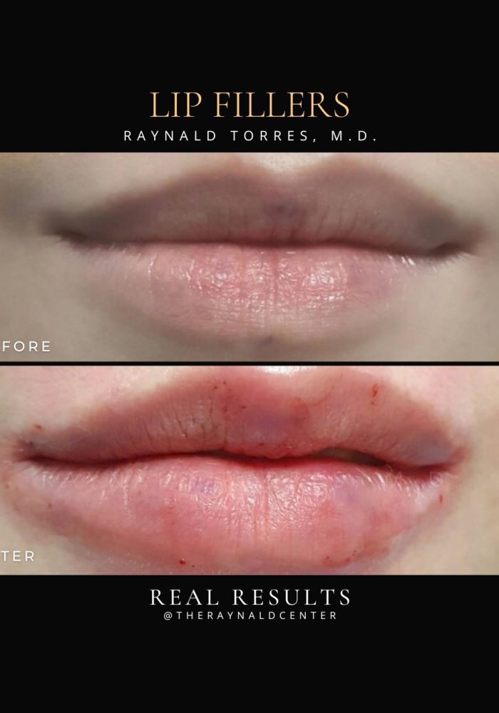 Lip Fillers_Before and After 2025 (1)