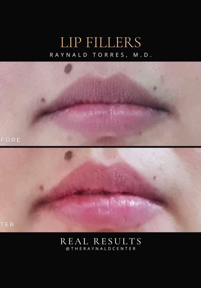 Lip Fillers_Before and After 2025 (2)