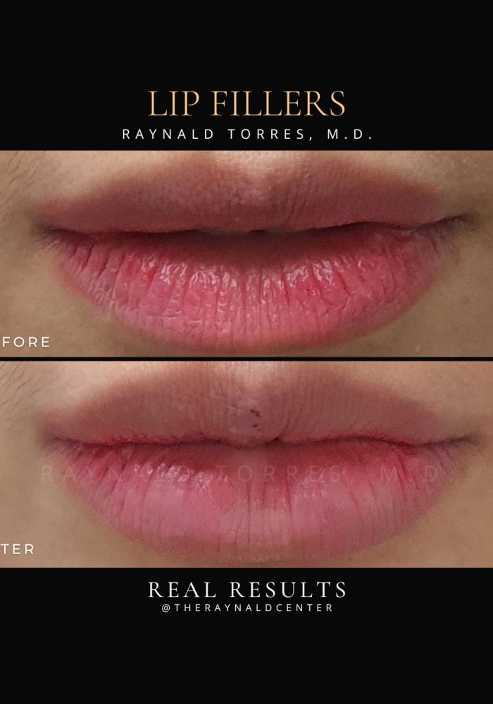 Lip Fillers_Before and After 2025 (3)
