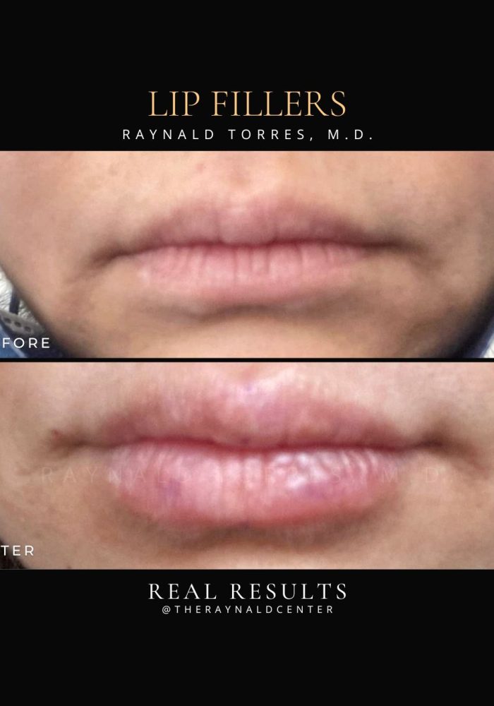 Lip Fillers_Before and After 2025 (4)