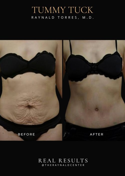 Tummy tuck 1