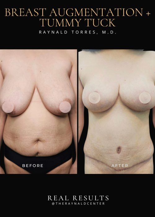 Tummy tuck 2