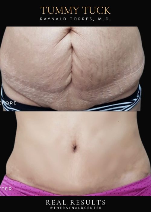 Tummy tuck 3