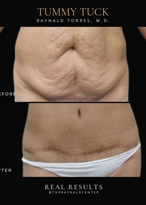 Tummy tuck 4