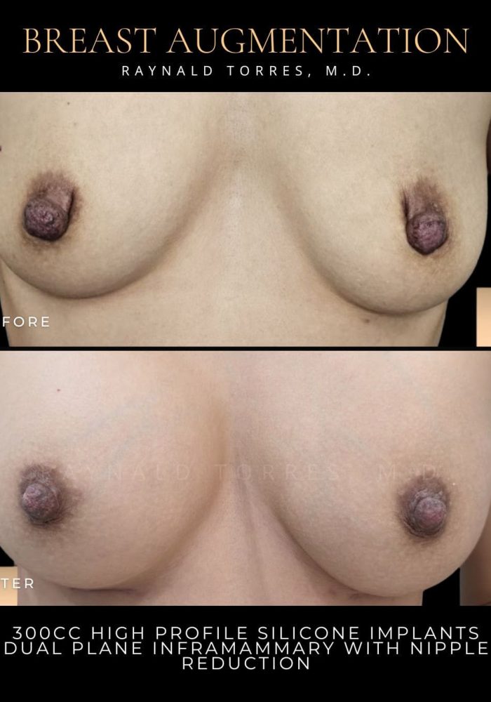 breast-augmentation1