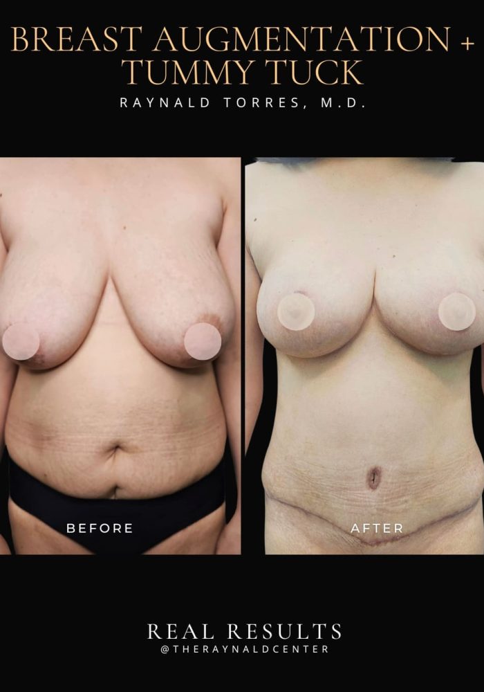 breast-augmentation2