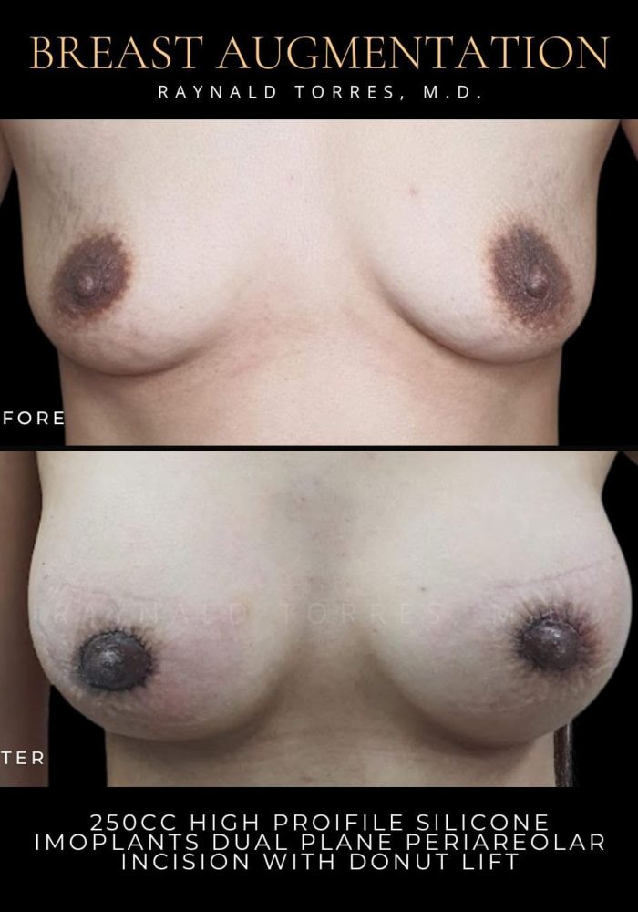 breast-augmentation4