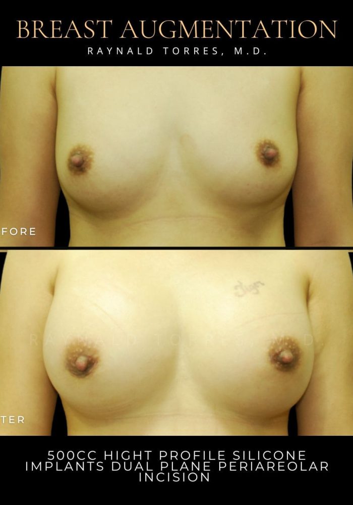 breast-augmentation5