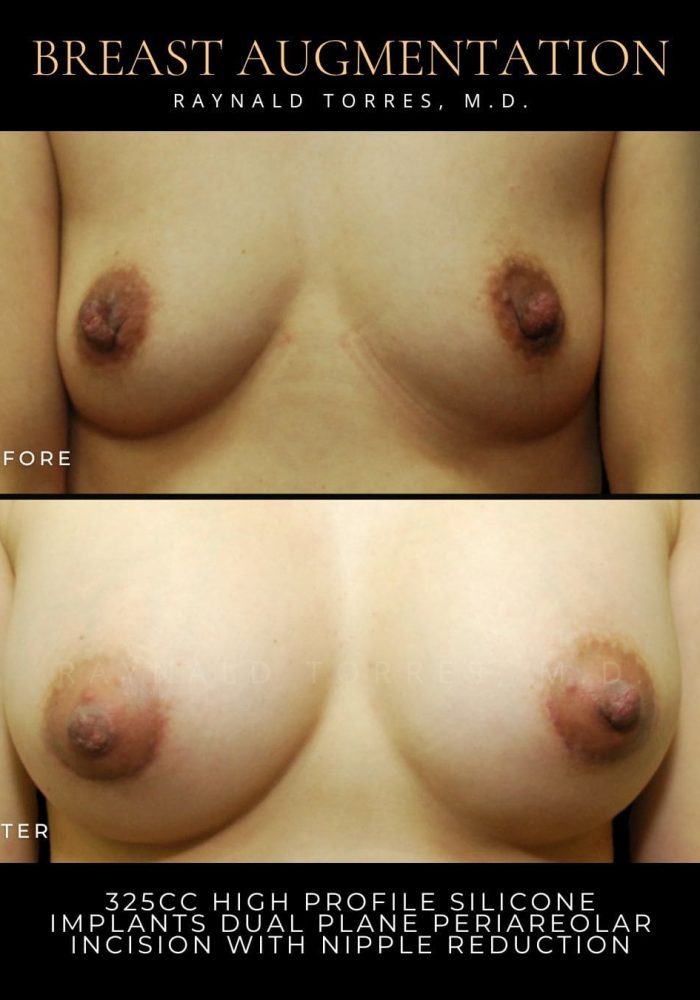 breast-augmentation6