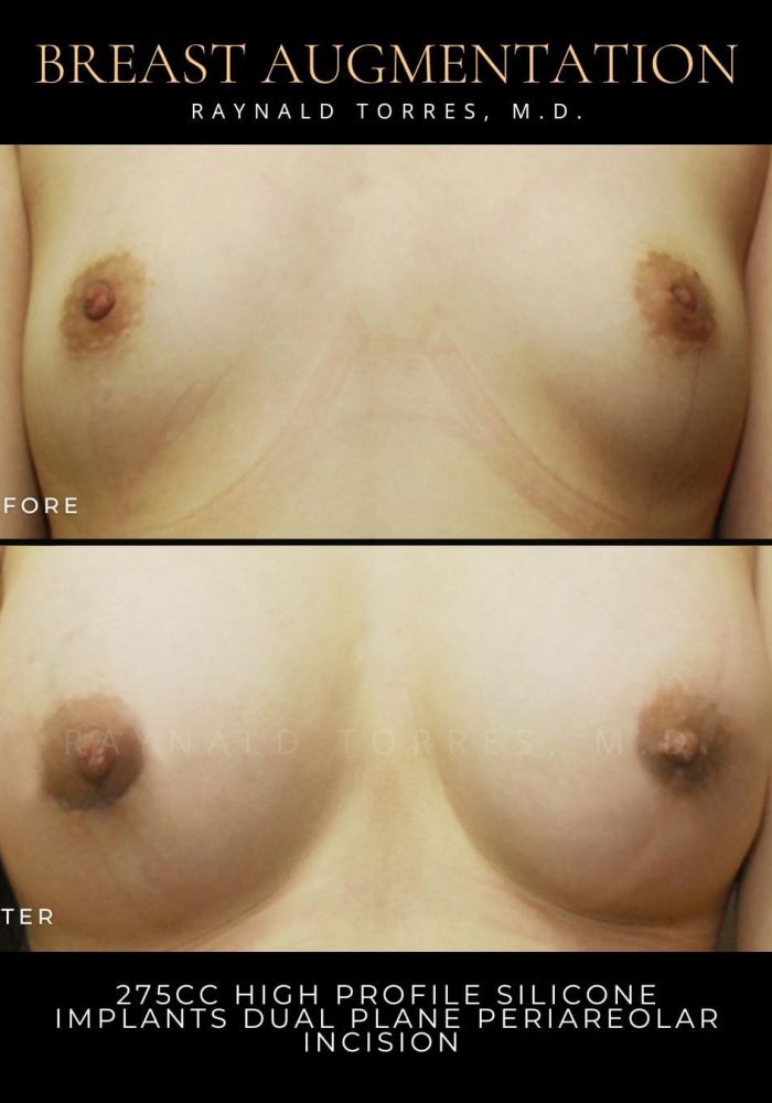 breast-augmentation7