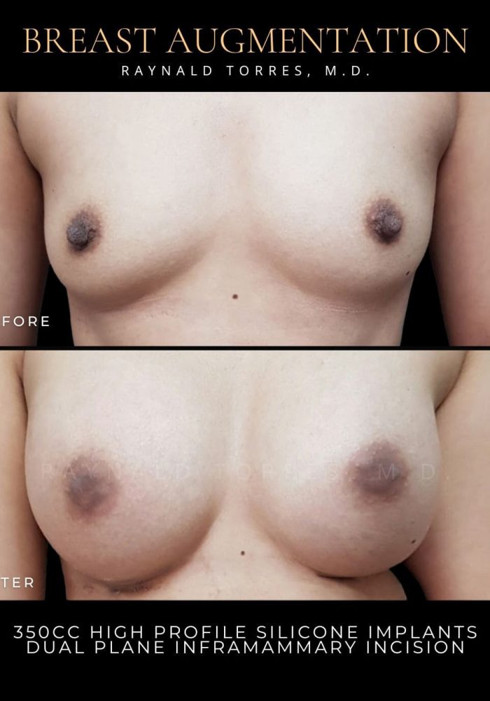 breast-augmentation8