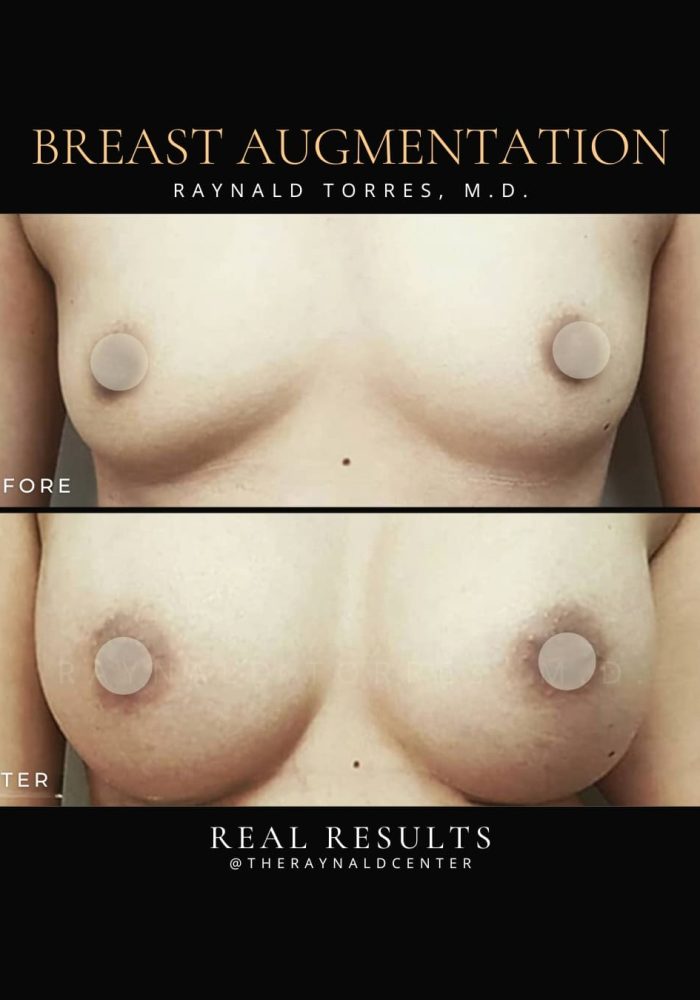 breast-augmentation9
