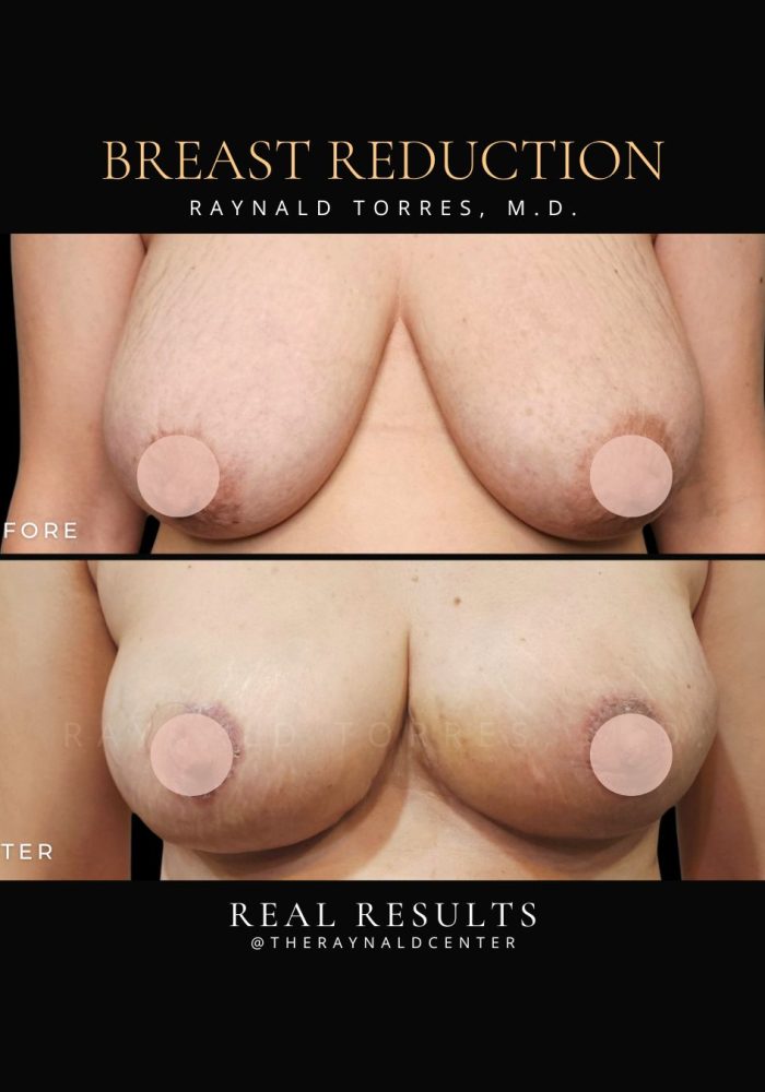 breast-reduction1
