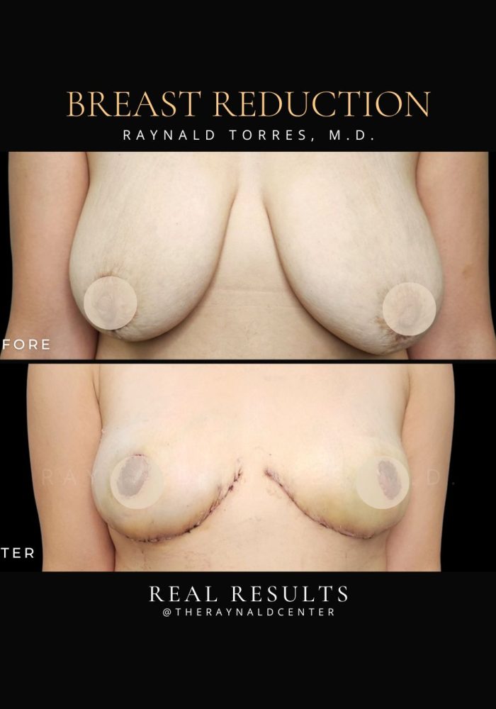 breast-reduction2