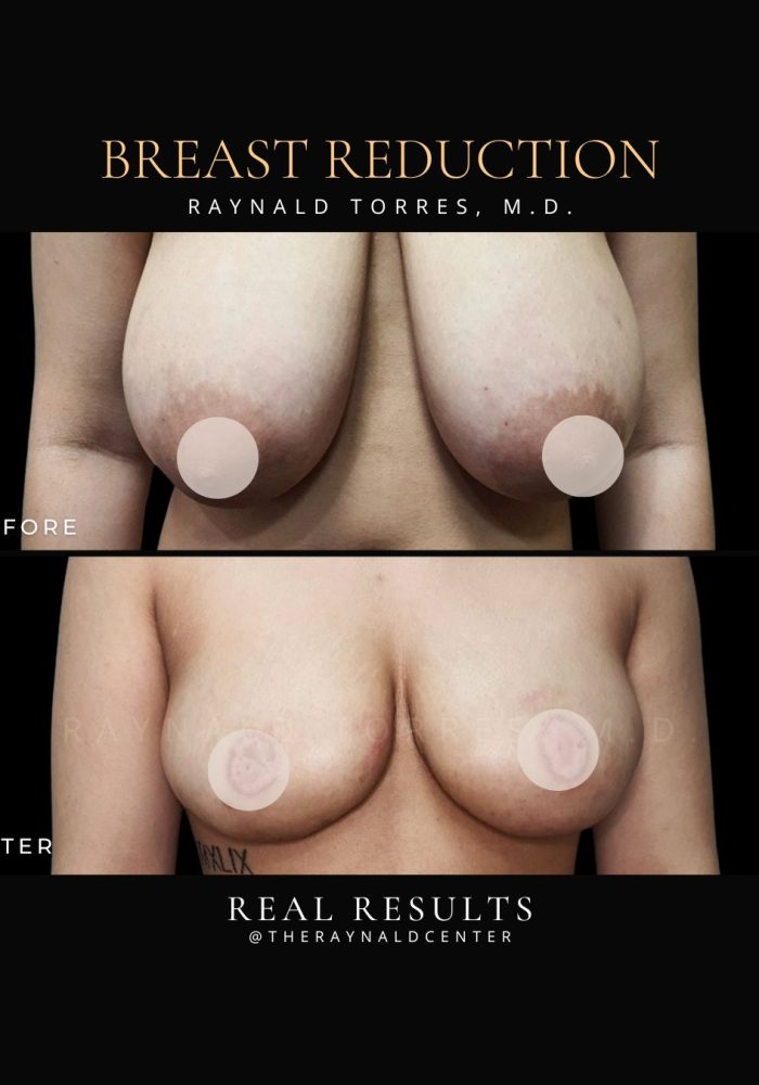 breast-reduction3