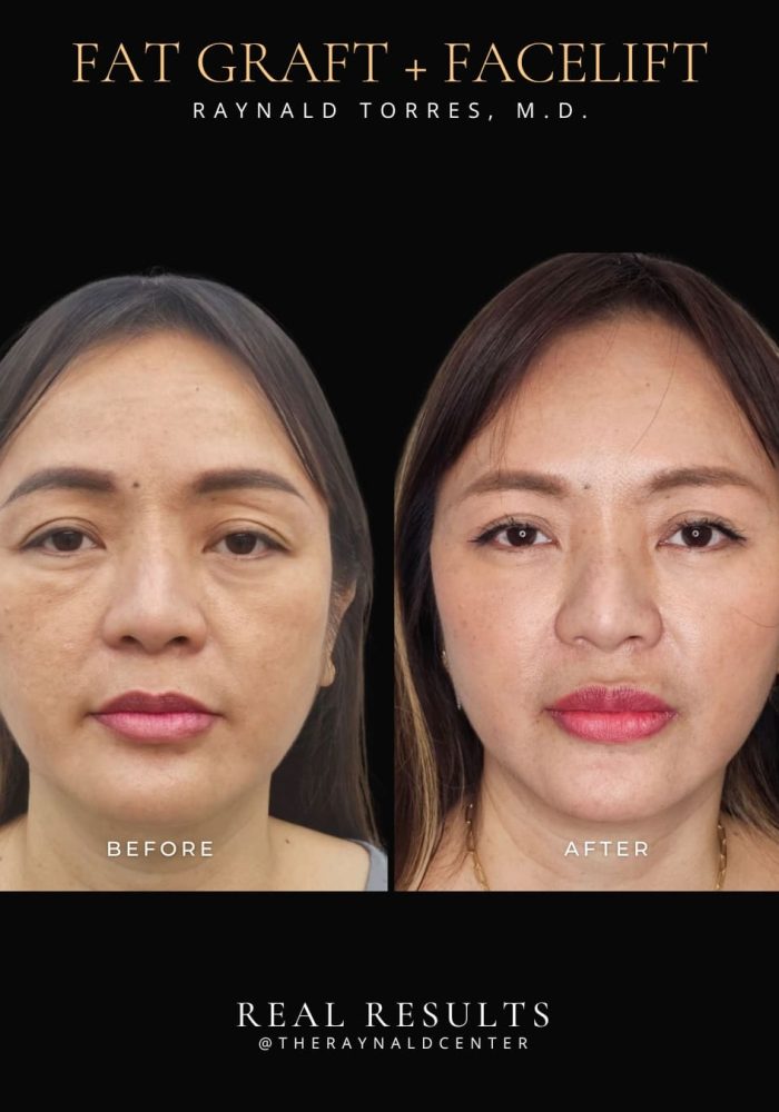 facelift1