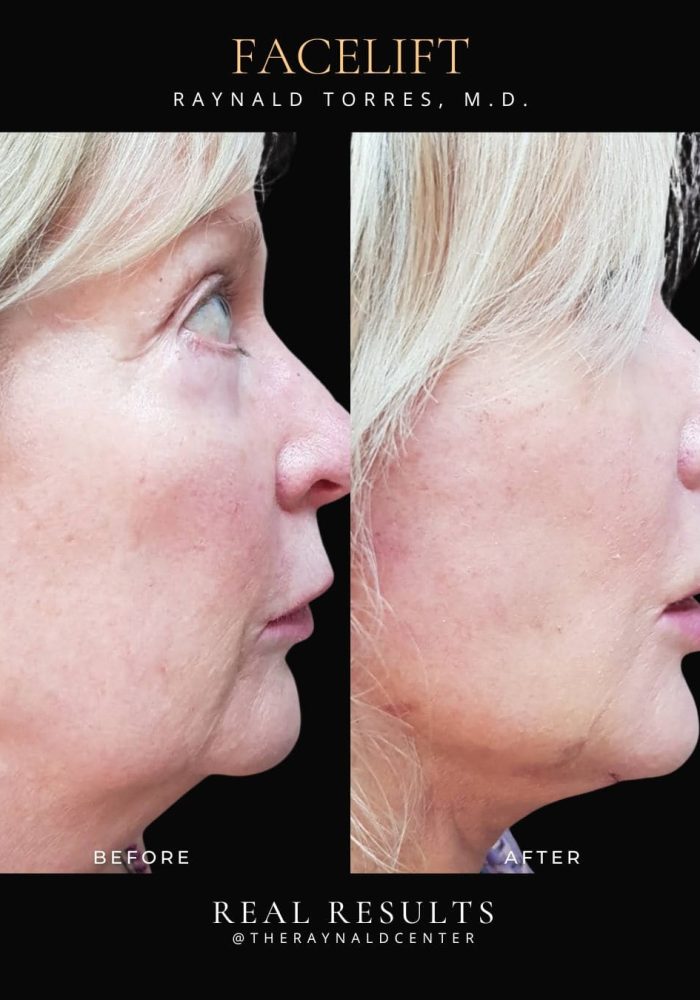 facelift10