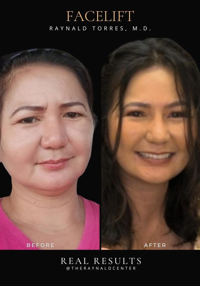 facelift11