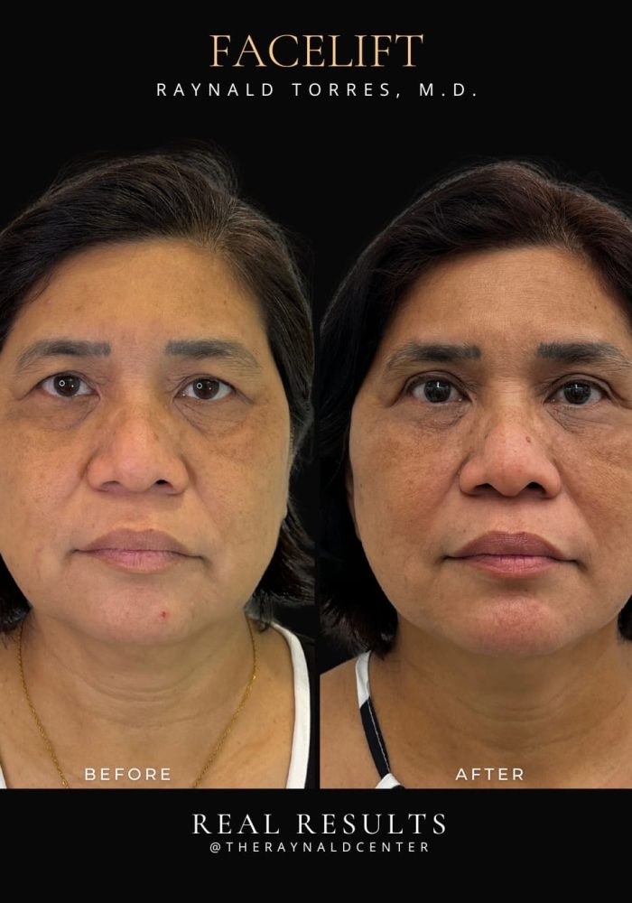 facelift12