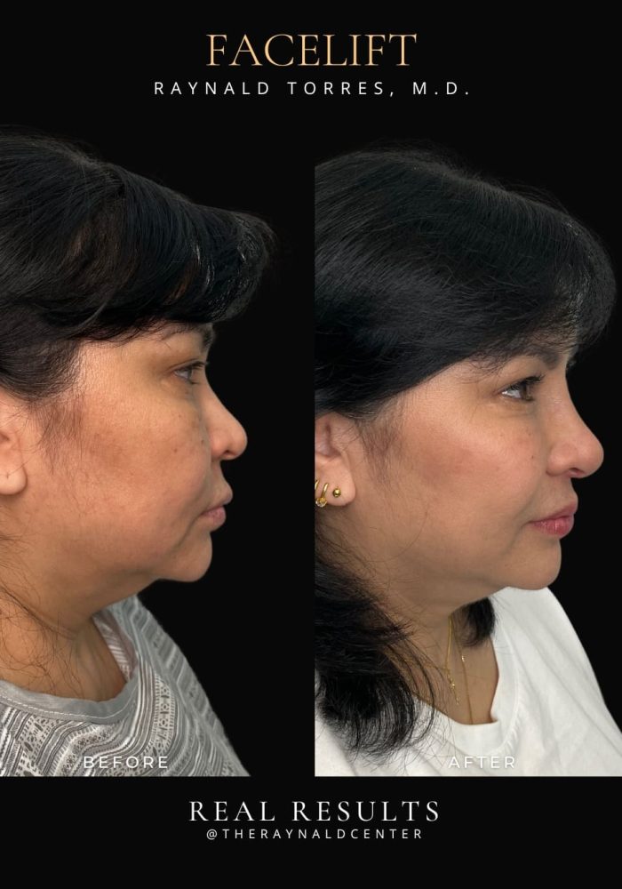 facelift13