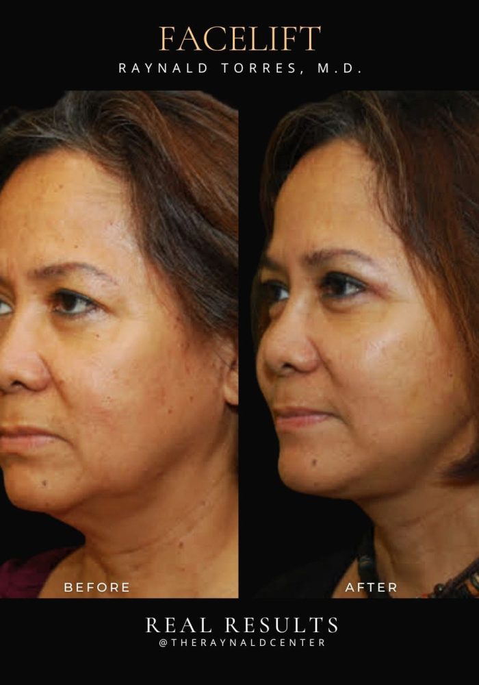 facelift14