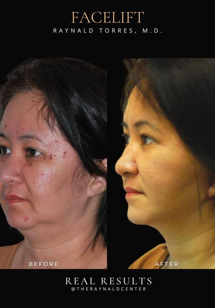 facelift15