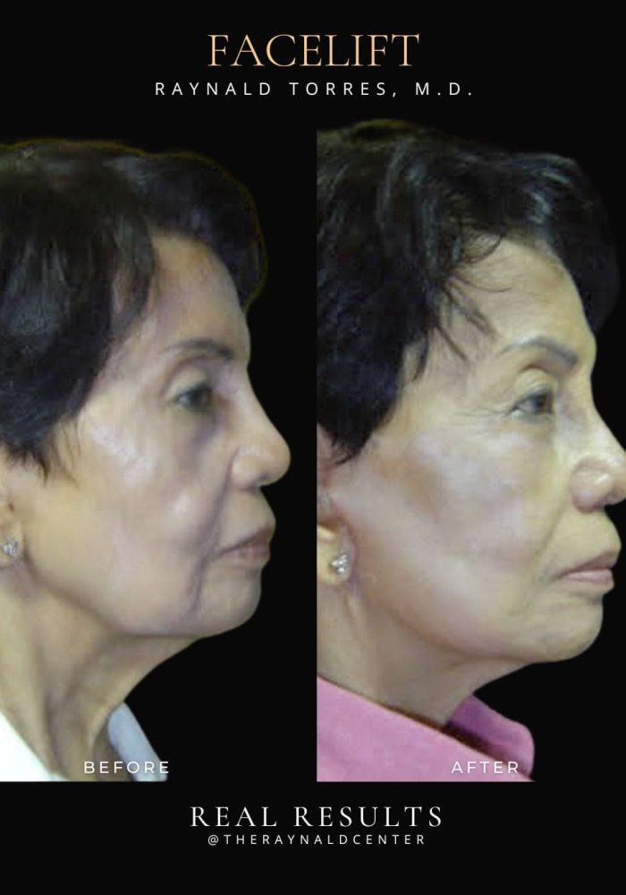 facelift16