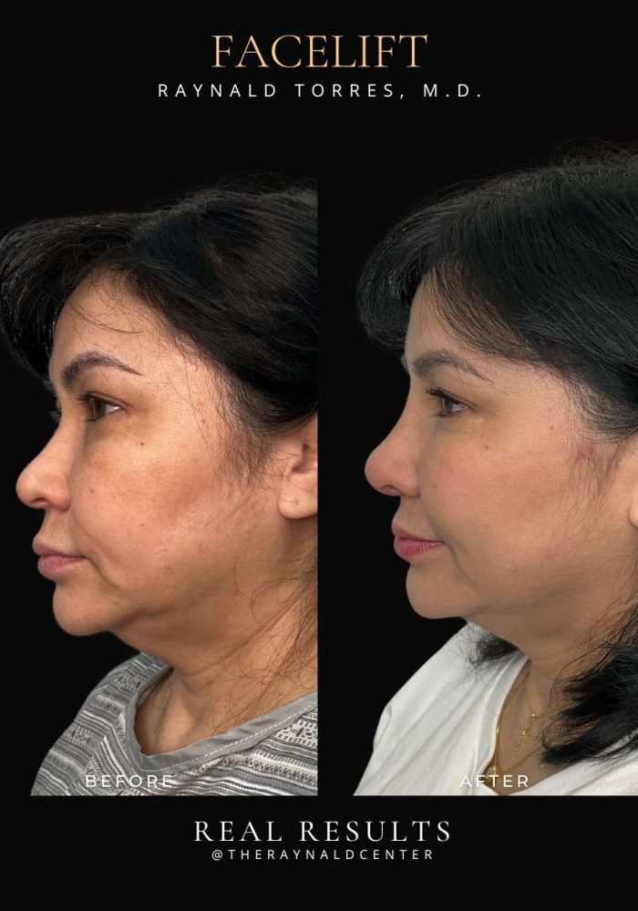 facelift2