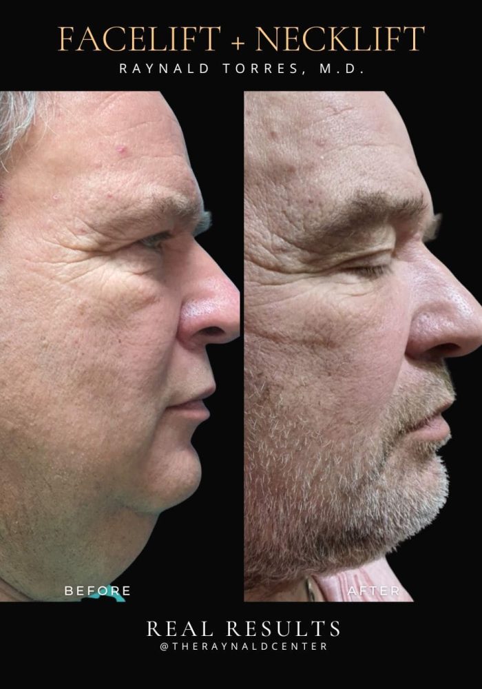 facelift3