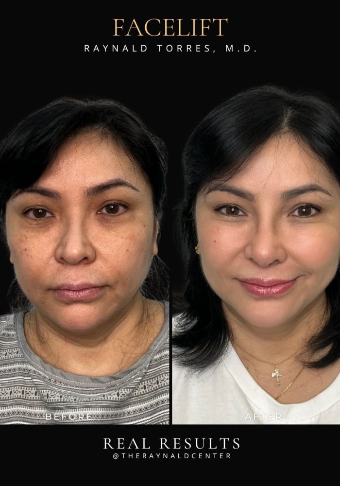 facelift4